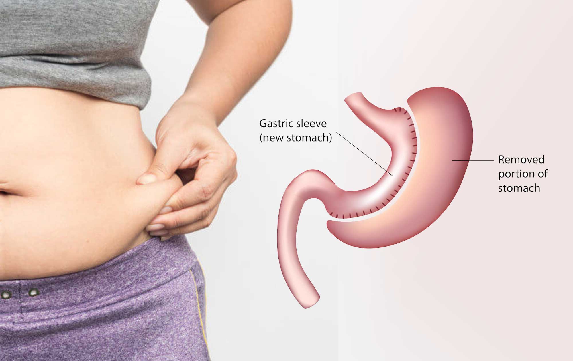 gastric sleeve surgery Melbourne